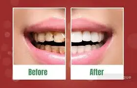 ProDentim Reviews 2024: Before and after comparison of teeth using ProDentim